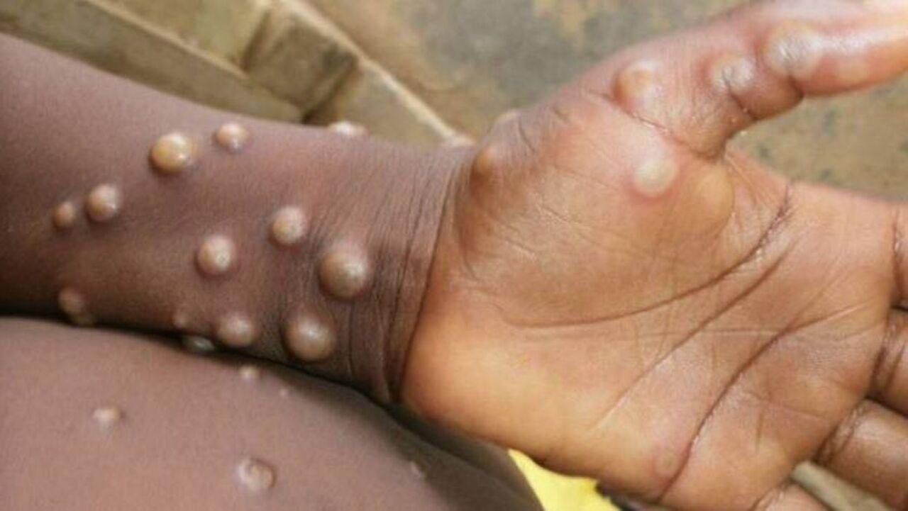 Cientistas veem "risco iminente" de varíola dos macacos chegar ao Brasil